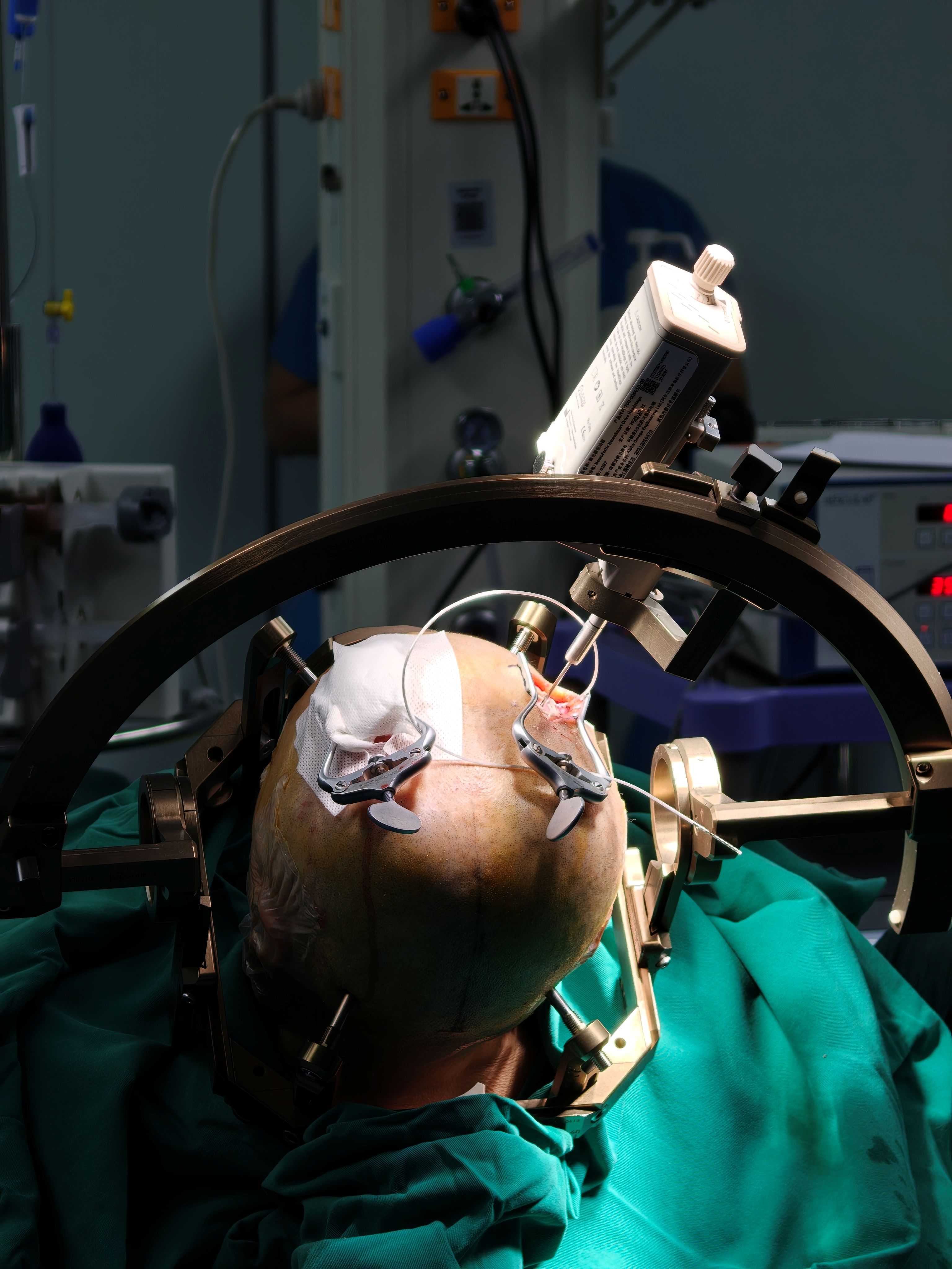 北京博仁医院完成首例帕金森病双靶点四通道方向性电极DBS手术